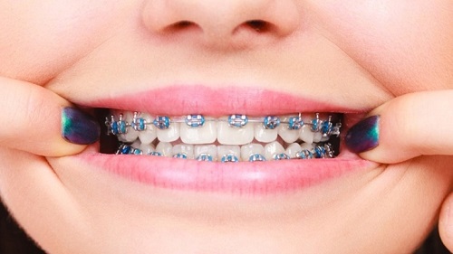 Niềng răng cho trẻ 10 tuổi - Tìm hiểu ngay 3