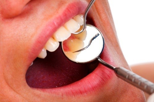 Niềng răng bị sưng lợi - Cảnh báo các nguy cơ cho bạn 3