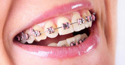 Niềng răng chỉnh hàm lệch hiệu quả không? 2