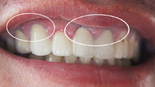 Bọc răng sứ bị thâm lợi - cách khắc phục hiệu quả 1