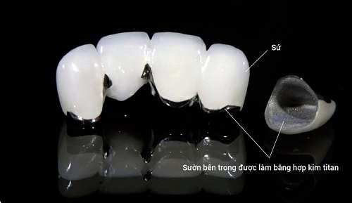 Bọc răng sứ bị thâm lợi - cách khắc phục hiệu quả 2