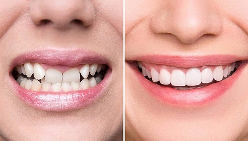 Bọc răng sứ có tác hại gì không? Lời khuyên từ nha khoa 1