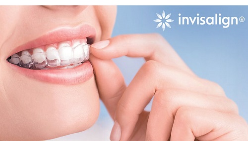 Niềng răng invisalign có nhổ răng không? Cần giải đáp 2