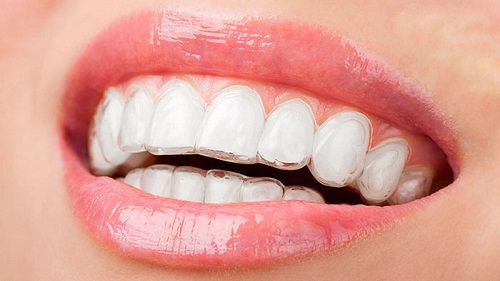 Niềng răng invisalign có nhổ răng không? Cần giải đáp 3