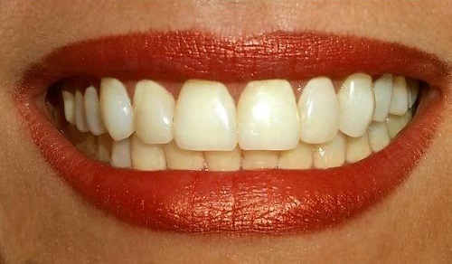 Răng sứ bị vàng - Nguyên nhân và cách khắc phục 2
