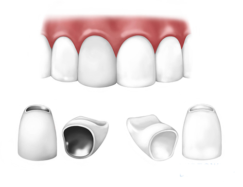 Răng sứ bị vàng - Nguyên nhân và cách khắc phục 3