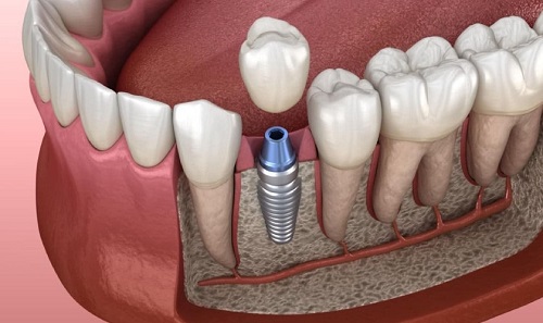Kinh nghiệm làm răng implant từ khách hàng 1