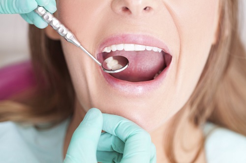 Kinh nghiệm làm răng implant từ khách hàng 2