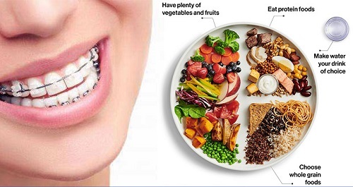 Niềng răng ăn cháo bao lâu là ăn bình thường? 2