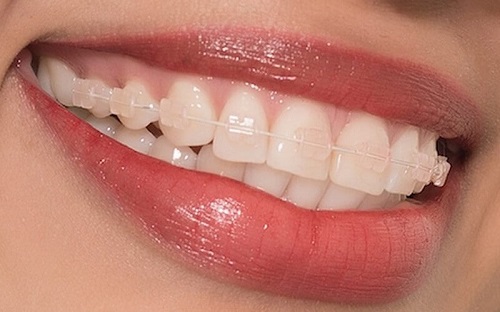 Niềng răng không đều - Phương pháp thẩm mỹ 1