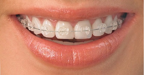 Niềng răng không đều - Phương pháp thẩm mỹ 2