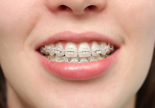 Niềng răng không đều - Phương pháp thẩm mỹ 3