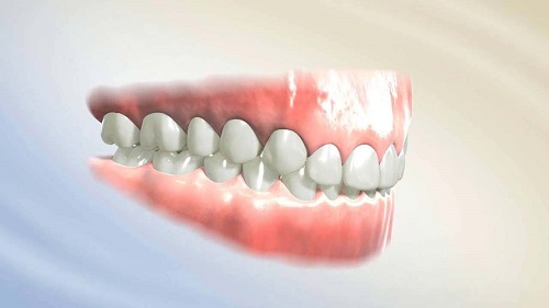 Niềng răng khớp cắn sâu - Tác hại và phương pháp niềng răng 1