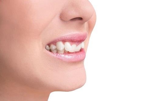 Niềng răng khớp cắn sâu - Tác hại và phương pháp niềng răng 2