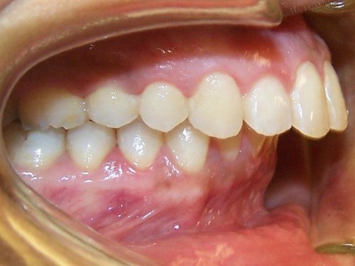 Niềng răng khớp cắn sâu - Tác hại và phương pháp niềng răng 3