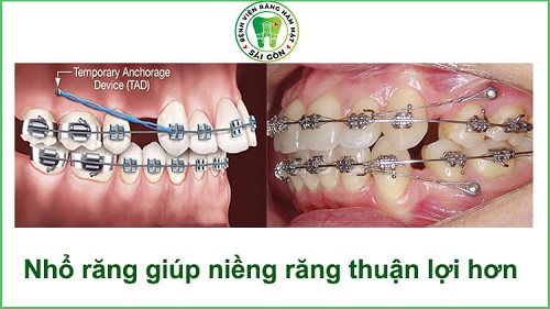 Niềng răng phải nhổ răng nào là hợp lý? 1