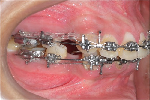Niềng răng phải nhổ răng nào là hợp lý? 2