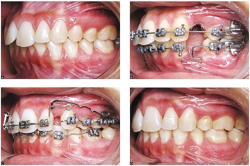 Niềng răng xong có bị hô lại không? Giải pháp tối ưu 2